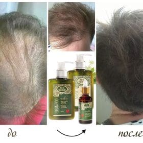 BIO REHAB бърз растеж на косата