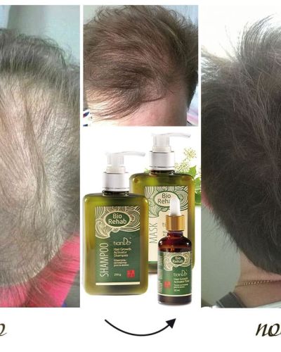 BIO REHAB комплект за бърз растеж на косата ПРОМО