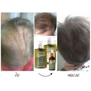 Комплект за бърз растеж на косата BIO REHAB